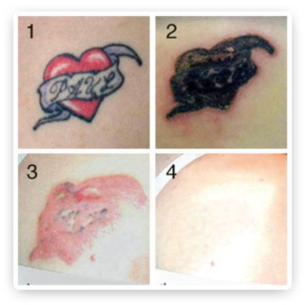 Worst Tattoo Removal Disasters, Yuck! - Likes