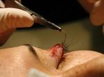 Implant de gene