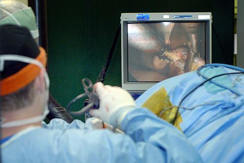 Operatie laparoscopica