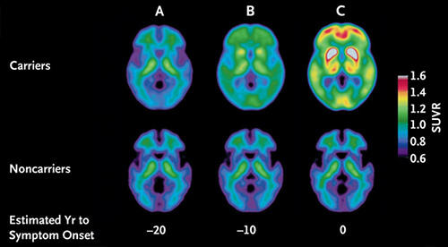 Detectare precoce a bolii Alzheimer