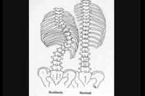 Scolioza deformeaza coloana vertebrala