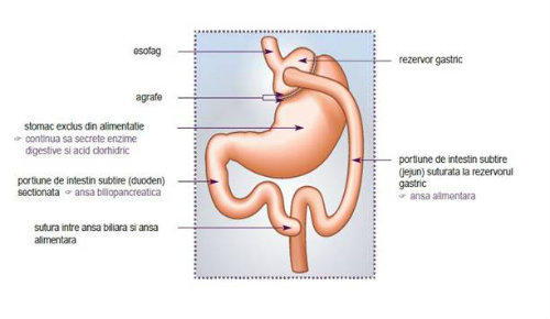 Bypass gastric