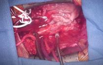 Transplant reusit de inima de porc la om