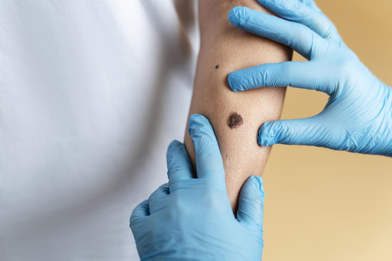 Cum se poate trece peste diagnosticul de melanom, când este depistat la timp