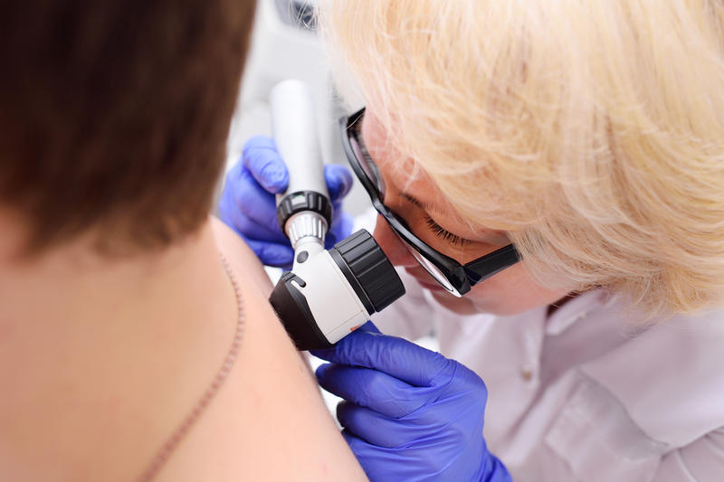 Unele tipuri de cancer de piele apar în zonele cele mai expuse la soare