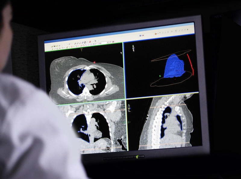 Cancerul pulmonar depistat în stdii incipiente are șanse mult mai mari de vindecare