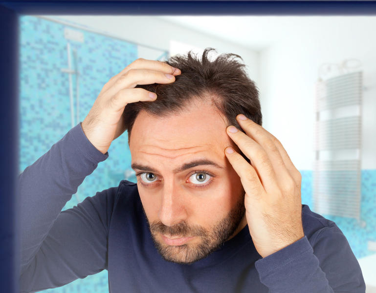 Pierderea părului din cauză ereditară poate afecta atât bărbații, cât și femeile